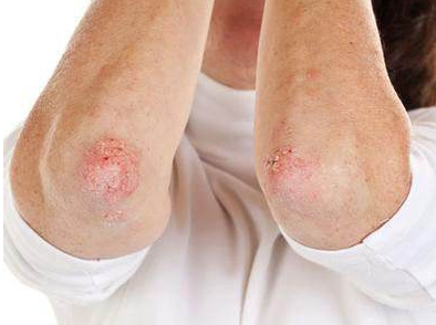 体癣有哪些危害，这样做能将危害降至最低
